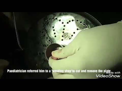 3yrs boy finger got trapped in Idiyappam Plate. removed successfully by Dr.Kasi watch completely