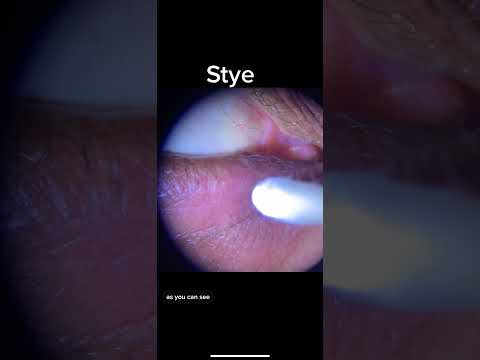 Eyelid Stye- expression and treatment