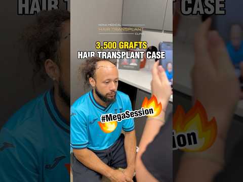 🔥3,500 Grafts Hair Transplant Case with Dr. Gartner / #hairsurgery #hairnewjersey #fuehair