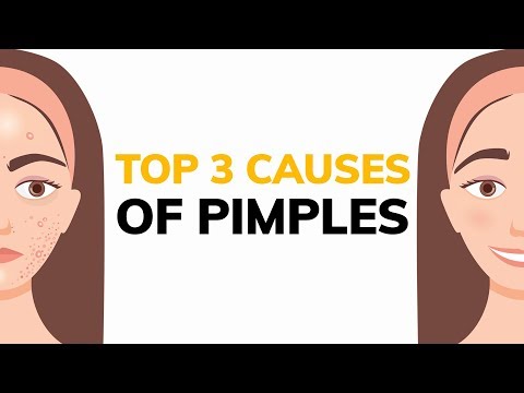 What's causing your pimples?