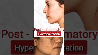 Post-Inflammatory Hyperpigmentation: Dermatologist Tips for Clear Skin"#Hyperpigmentation #DarkSpots