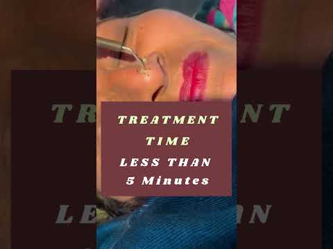 Safe & Painless Wart Removal |  Wart on Face |   Best Wart Removal Treatment Jammu