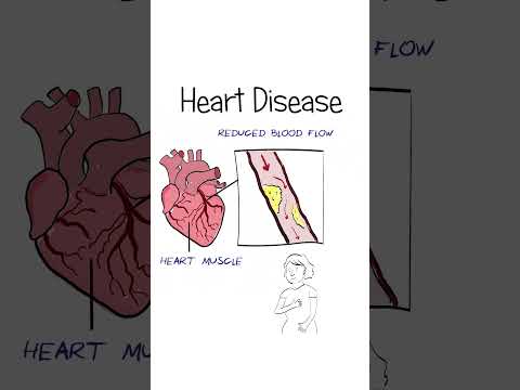 Heart Attacks EXPLAINED #healthsketch #shorts