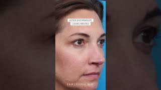 Eye Bags (Even with Makeup) | Gone with Quadfecta Lift | Dr. Kami Parsa