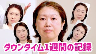 【肌の再生医療】ダウンタイム、全部見せます（40代女性症例）【しわ・たるみの治療】