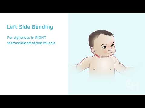 Congenital Muscular Torticollis: Stretching