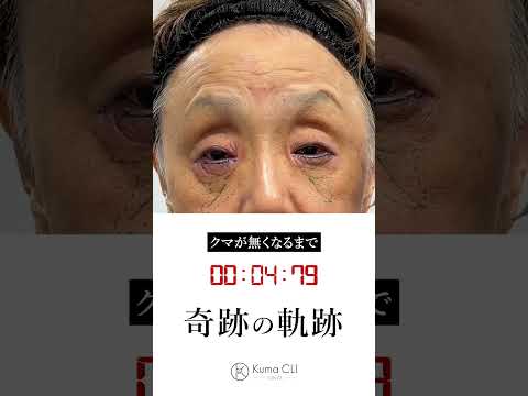 【60代のクマ治療】劇的ビフォーアフター#クマ取り #クマ改善 #目の下のクマ取り #shorts