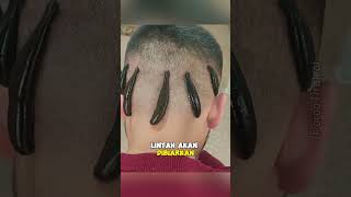 Tirudoterapi atau terapi lintah #shorts