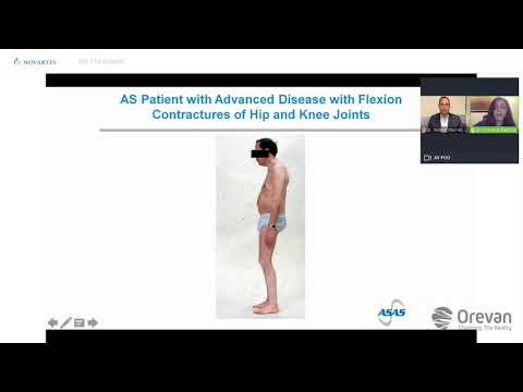 Back pain from Ankylosing Spondylitis or Seronegative Spondyloarthritis