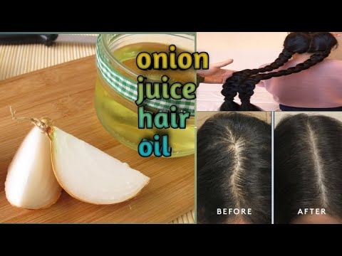 Onion juice hair oil , for hair growth|| बाल का झड़ना और गंजा पान से छुटकारे के लिए