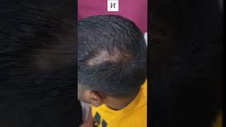 Alopecia? No confusion #drchabra #hairlosstreatment #hairfallkaiseroke #hairstyle #hairgrowth