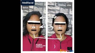 #medifacial #detanfacial #detanning #face #skinwhitening skin #skinlightening #glowingskin #skincare