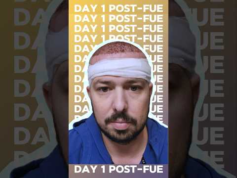 🚀FUE Hair Transplant: 4-Week Time Lapse / #hairtransplantfue #hairtransformation