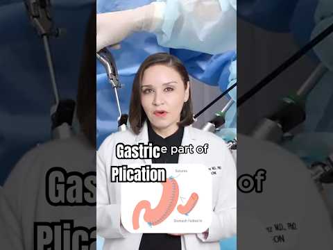 Curious about bariatric surgery options? 🤔 Dr. Rodríguez explains Gastric Plication