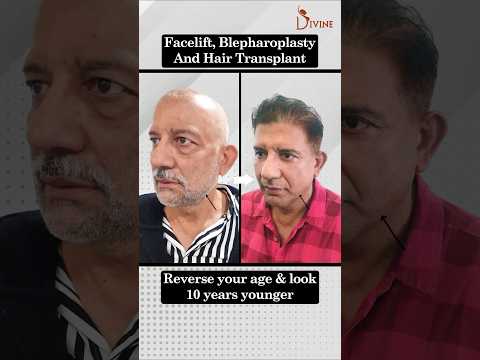 Hair Transplant, Facelift & Eyelid Surgery for a Youthful Look #ytshorts