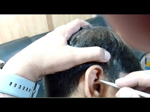 Removing Overflowed Ear wax / ear wax removal asmr#earwax #satisfying