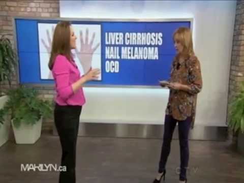 Dr. Carroll On What Your Nails Can Tell You