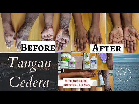 Tangan Cedera Diubati Dengan Power of Nutrilite + Artistry + Allano | Hand Injury