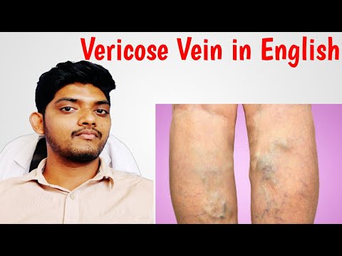 Varicose Vein Treatment/Prevention In English-Episode-15