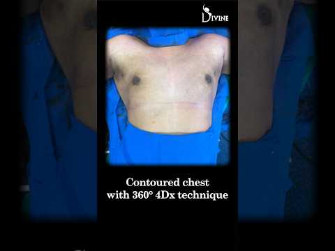 Grade 4A Gynecomastia Fixed: 360° 4Dx for a Sculpted Chest! #shortfeed