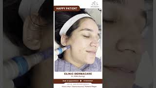 Happy patient!Skin has transformed from dry and textured to smooth and glowing with minimized pores!
