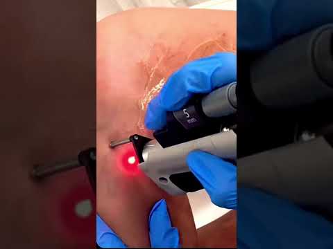 Vein removal made easy! Using laser we’re removing this client’s stubborn veins!