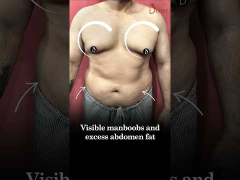 Gynecomastia and Abdomen Liposuction Result: From Man Boobs to a Sculpted Chest & Abs!