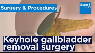 How keyhole gallbladder removal surgery is carried out
