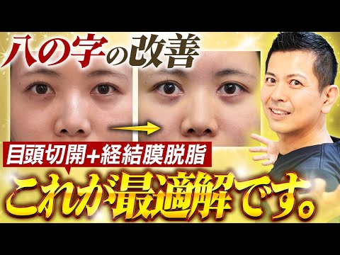 八の字改善の最適解はこれ！クマ治療+目頭切開+ゴルゴ線治療でさらに美しくなった患者様をご紹介します！【クマ取り/整形】