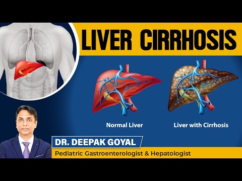 Liver Cirrhosis कारण और लक्षण!!