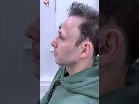 Jawline filler for male clients is done differently from females. The more square, more masculine !