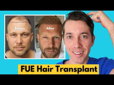 FUE Hair Transplant Transforms Your Hairline