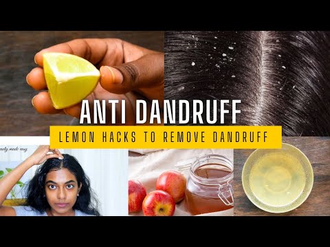 Lemon Hair Mask Hacks: The Secret to Fighting Dandruff Naturally