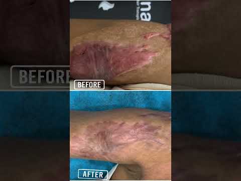 Effective Keloid Scar Treatment | Important Things | Skinaa Clinic #viral #shortfeed