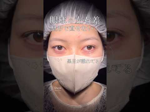 [Double eyelid surgery] Are there limits to plastic surgery? #shorts