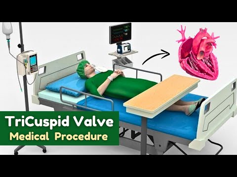 Tricuspid valve ' Medical Procedure Animation