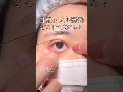 [Full eye surgery] How much will it change? #shorts