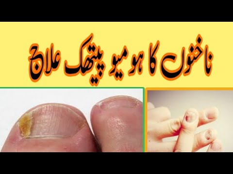 ناخنوں کا ہومیو پیتھک علاج || Health Tips Home