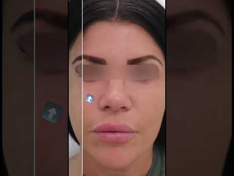 Undereye circle correction by dermal filler injection 💉!  #torontoblogger #torontolife #avebelle