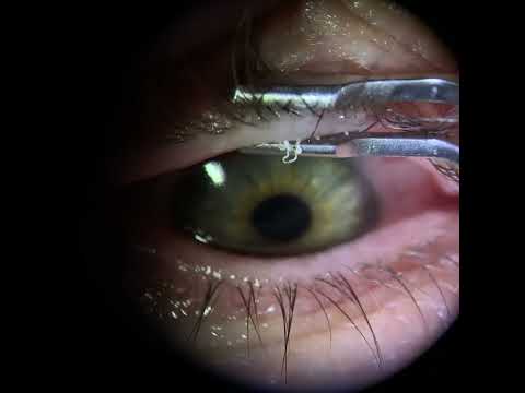 Meibomian Gland Expression