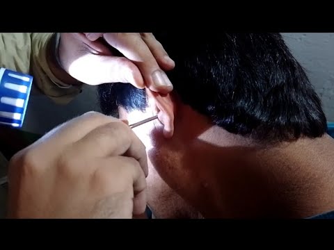 An Urgent  Request  For Removal of Irritating Ear Wax / ASMR EAR WAX REMOVAL #earwax #waxremoval