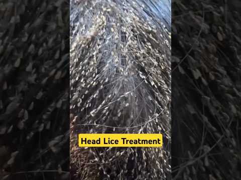 Get rid of Head LICE and EGGS! #headliceremoval #headlice #shorts #dadumedicalcentre