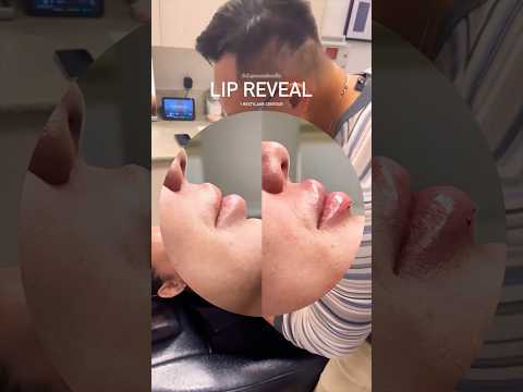 😍Loving this Lip Before & After 😍 #lips #lipfillers #lippies #lipinjections #filler #fillerlips 💋