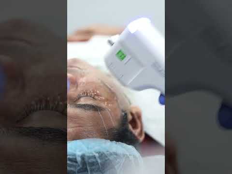 What is a HIFU Facelift? Watch How It’s Done at Skinaa Clinic! #viral #skinaaclinic