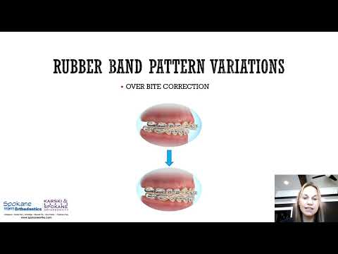 Orthodontic Rubber Bands