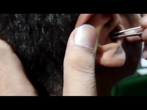 See what happened at the end ! unbelievable  massive  ear wax ! #earwax #asmr