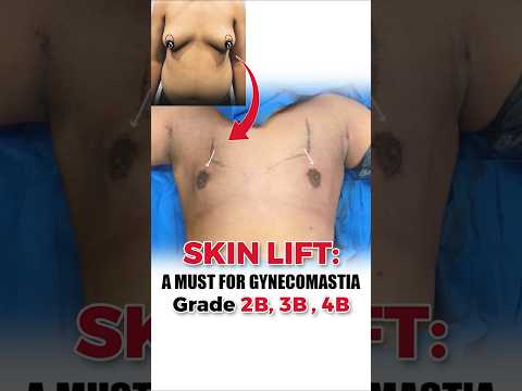 Skin Lift: A Must for Gynecomastia Grade 2B, 3B and 4B | #ytshorts