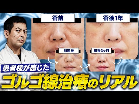 ゴルゴ線治療 術後1年の経過とダウンタイムのリアルを全てお見せします！