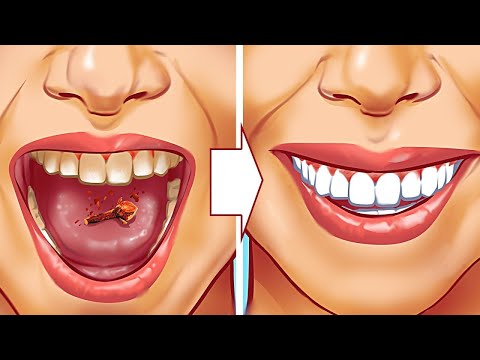 9 Natural Ways to Remove Plaque & Tartar Buildup