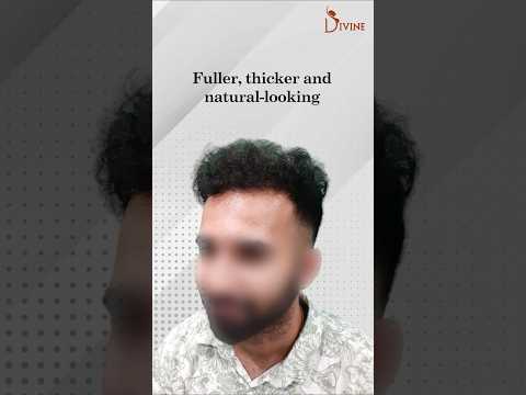 8-Month FUT Hair Transplant Transformation | 5,500 Follicles Restored!